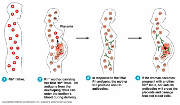 pathology of erythroblastosis fetalis 