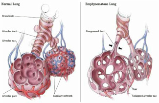 pathology of emphysema 