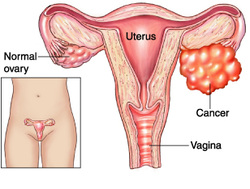 pathology of ovarian tumor of sex cord stromal origins
