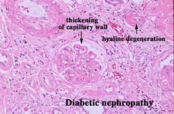 pathology of diabetic nephropathy