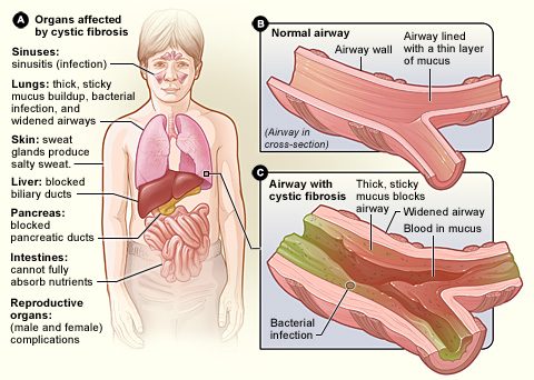 Pediatric Definition - Cystic Fibrosis 