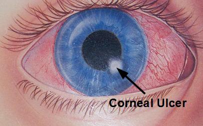 medical zone - corneal ulcer 