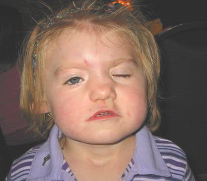 Pediatric definition - CHARGE Syndrome 