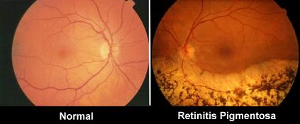 Differential diagnosis of retinitis pigmentosa 