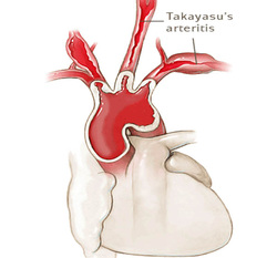 pathology of takayasu arteritis