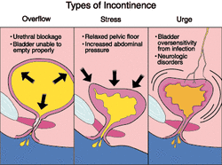 the causes of urinary incontinence
