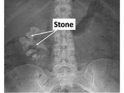 pathology of renal stone