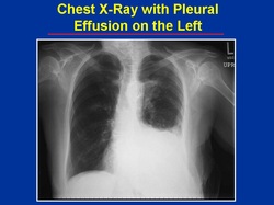clinical examination of pleural effusion 