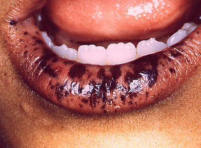 medical zone - oral pigmentation 