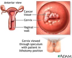 pathology of cervical cancer
