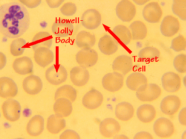medical zone - howell jolly bodies 
