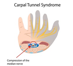 how to treat carpal tunnel syndrome