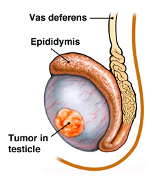 pathology of testicular germ cell tumors