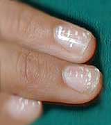 causes of nail abnormalities