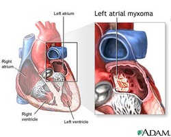 Pathology of cardiac tumors