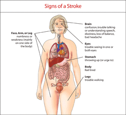 clinical examination of stroke