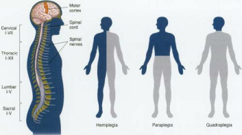 causes of hemiplegia