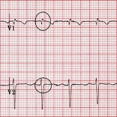 differential diagnosis of dominant R wave on v1