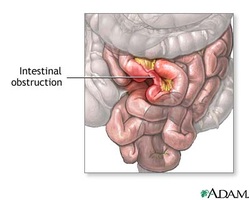 the causes of intestinal obstruction