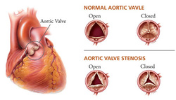 clinical examination of aortic stenosis 