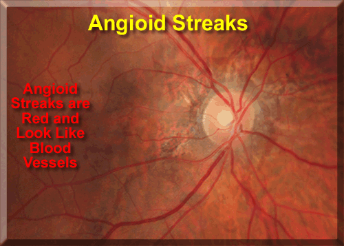 medical zone - angioid streak 