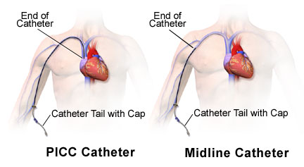 how to insert midline catheter