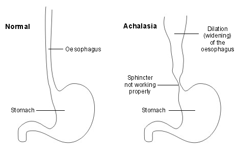 what is achalasia 