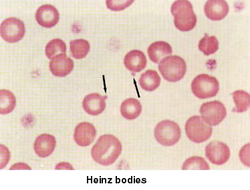 pathology of Heinz bodies