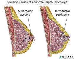 causes of nipple discharge