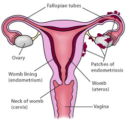 pathology of endometriosis 