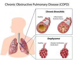 clinical examination of chronic obstructive pulmonary disease