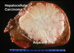 pathology of hepatocellular carcinoma