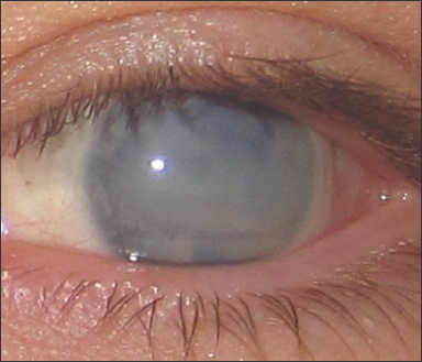 medical zone corneal opacification 