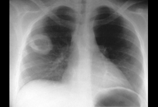 medical zone - cavitating lung lesion 