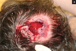 the causes of scalp lesion