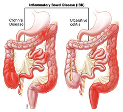 pathology of Crohn's disease