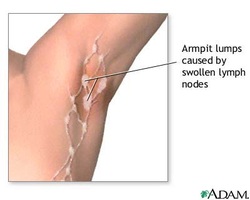 Symptom finder- the causes of axillary swelling 