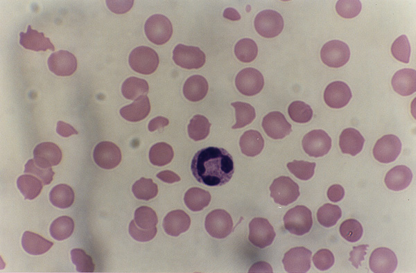 medical zone - normocytic anemia 