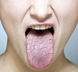 medical zone - dry mouth 