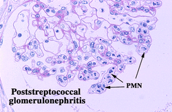 pathology of post streptococcal glomerulonephritis 