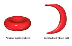pathology of sickle cell disease