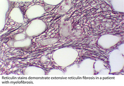 pathology of myelofibrosis