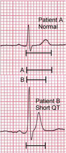 differential diagnosis of short qt interval 
