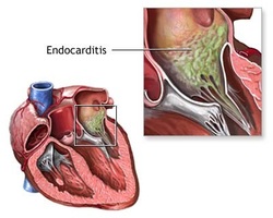 pathology of endocarditis 