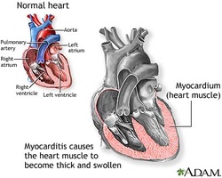 pathology of myocarditis 
