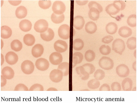 medical zone - microcytic anemia 