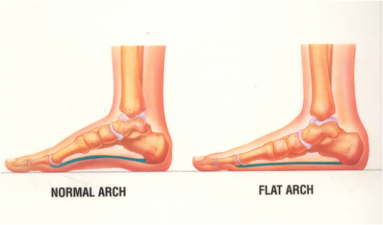 Pediatric Definition - Flatfoot