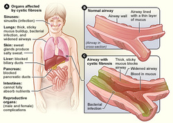 pathology of cystic fibrosis 