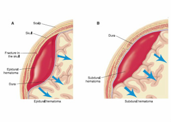 pathology of epidural hematoma 