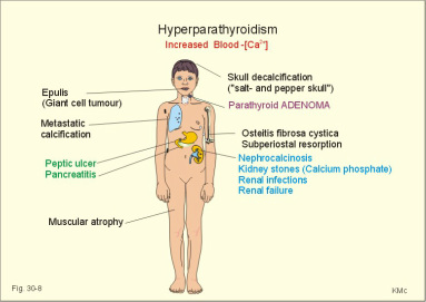 pathology of primary hyperparathyroidism 